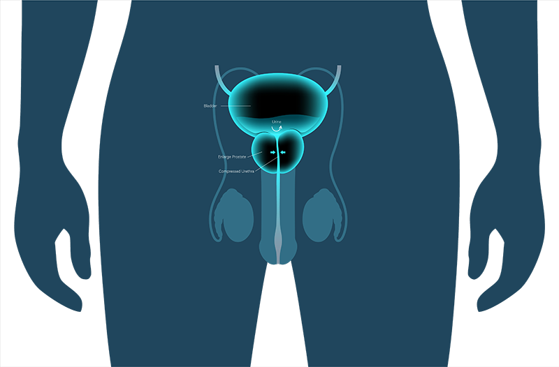 Enlarged prostate diagram